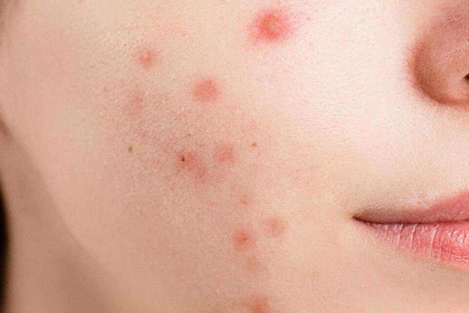 İzotretinoin Reçeteleme Koşulları Güncellendi: Risk Azaltma Önlemleri Revize Edildi